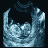 ARDMS OBGYN + Abdomen + Physics (SPI) Ultrasound Flashcards