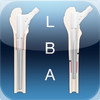 Revision femoral prosthesis